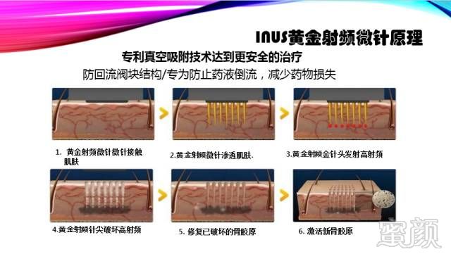 星空体育官方网站:相控射频技术美容的优势(图1)
